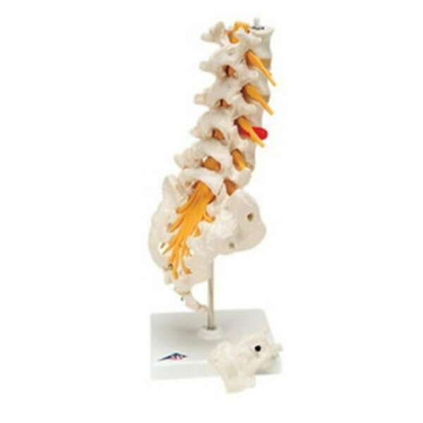 Toys4.0 Anatomical Model Lumbar Spinal Column with Dorso-Lateral Prolapsed Disc TO295978